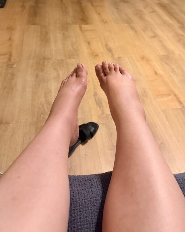 Client feet and ankles before lymphatic drainage — puffy